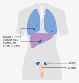Transparent Ovarian Cancer Ribbon Png - سرطان المبيض المرحلة الرابعة, Png Download, Free Download