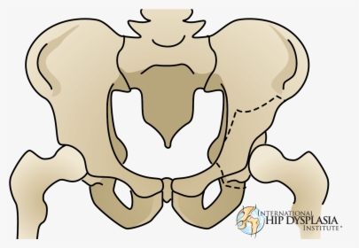 Ddh Osteotomy, HD Png Download, Free Download