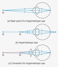 Presbyopia Correction Presbyopia Diagram, HD Png Download, Free Download