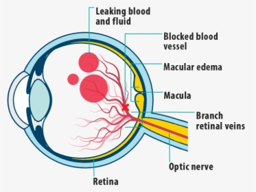 Picture Of Effects Of Mefbrvo On The Eye, Showing Leaking - Crvo With Macular Edema, HD Png Download, Free Download