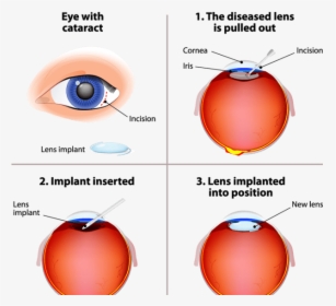 Cataract Surgery, HD Png Download, Free Download