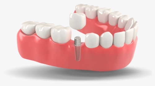 Menu-image - Dental Implants, HD Png Download, Free Download