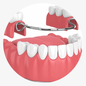 Dental Denture, HD Png Download, Free Download