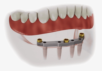 Removable Implant Overdentures - Implant Supported Denture, HD Png Download, Free Download