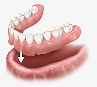 Implant Overdenture, HD Png Download, Free Download