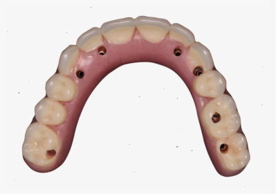 Fixed Implant Supported Dentures, HD Png Download, Free Download
