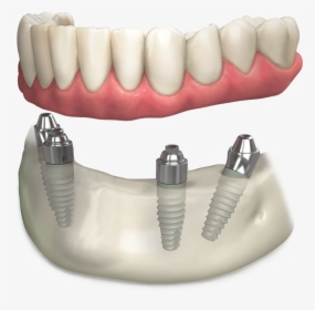 Multi-unit Abutment System - Tongue, HD Png Download, Free Download