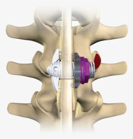 Minuteman Spinal Implant, HD Png Download, Free Download