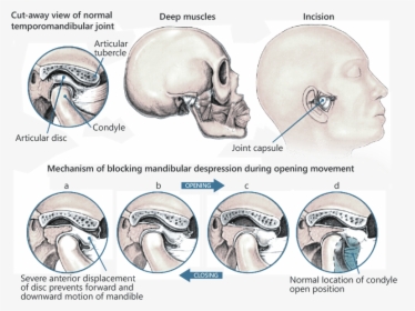 Tmj Specialist - Tmj Disorder, HD Png Download, Free Download