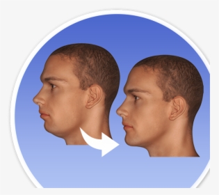 Before And After Jaw Surgery - Maxillofacial Jaw Surgery, HD Png Download, Free Download