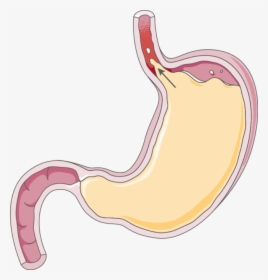 Gastroesophageal Reflux Disease Transparent, HD Png Download, Free Download