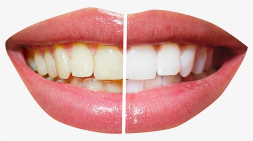 Teeth Png File - Teeth Whitening Png, Transparent Png, Free Download