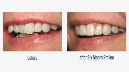Https - //www - Postfallsfamilydental - Com/uploads/6month - Six Month Smiles, HD Png Download, Free Download