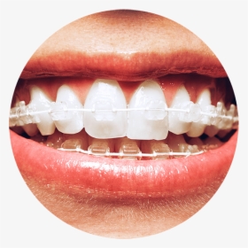 6 Month Smile Braces, HD Png Download, Free Download