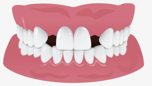 Invisalign Gap Teeth Missing Tooth, HD Png Download, Free Download