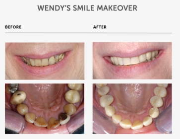 Weybridge Teeth Smile Makeover - Teeth Makeover, HD Png Download, Free Download