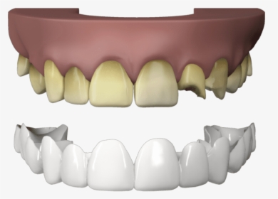 Press On Veneers Teeth - Dental Technician, HD Png Download, Free Download