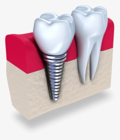 Implant Tooth Cost In Singapore, HD Png Download, Free Download