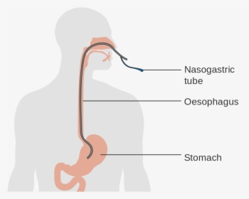 Nasogastric Tube Clipart, HD Png Download, Free Download