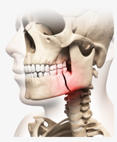 Illustration Of Skull With Broken Jaw Highlighted In - Jaw Fracture, HD Png Download, Free Download
