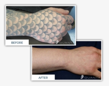 Chroma Tattoo Studio & Laser Tattoo Removal Clinic - Tattoo Removal Cover Up, HD Png Download, Free Download