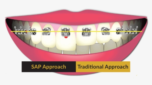 Sap Approach - Smile Arc Protection, HD Png Download, Free Download