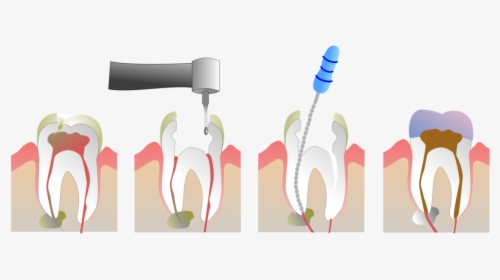 Root Canal Treatment In Colombia, HD Png Download, Free Download
