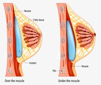 Breast Augmentation Dual Plane Technique, HD Png Download, Free Download
