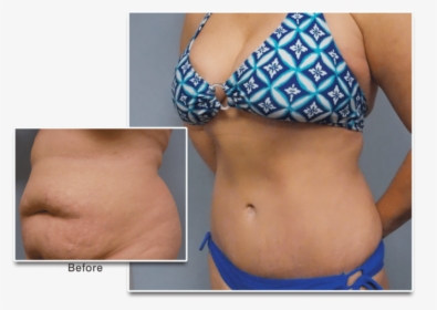 Mommymakoverba - Tummy Tuck Breast Lift Before And After, HD Png Download, Free Download