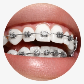 Silver Gold Braces, HD Png Download, Free Download
