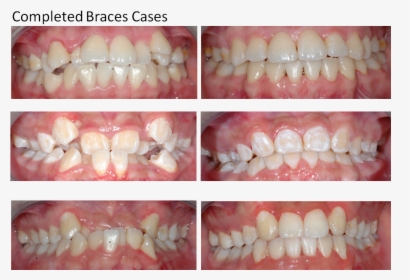 Dental Braces , Png Download - Tooth Bleaching, Transparent Png, Free Download