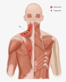 Trigger-pain - Botulinum Toxin For Neck Pain, HD Png Download, Free Download