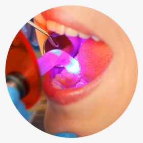 Transparent Dentist Tools Png - Polymerization Dental, Png Download, Free Download