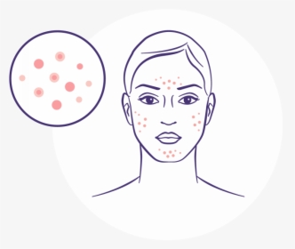 Acne Treatment - Illustration, HD Png Download, Free Download