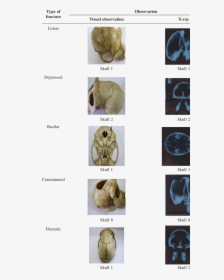 Types Of Fracture Of Skull, HD Png Download, Free Download