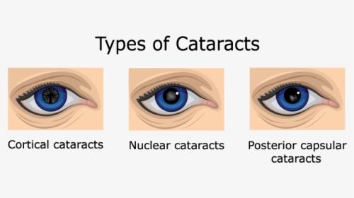 Nuclear Cataract Vs Cortical Cataract, HD Png Download, Free Download
