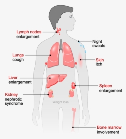 Side Effects From Exposure - Man Lymphoma Cancer Symptoms, HD Png Download, Free Download