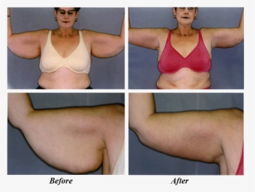 Before & After Arm Lift - Brassiere, HD Png Download, Free Download