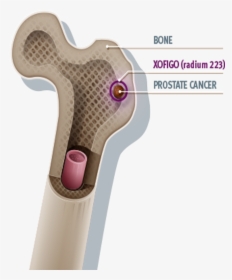 Bone - Xofigo Radium 223, HD Png Download, Free Download