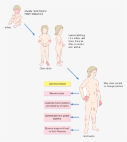 Pattern Of Atopic Eczema Varies With Age - Causes Itching All Over The Body, HD Png Download, Free Download