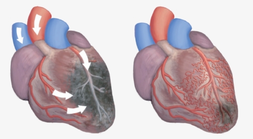 Alt="illustration Of Two Hearts, One Showing Ischemia - Eecp Effects On Heart, HD Png Download, Free Download