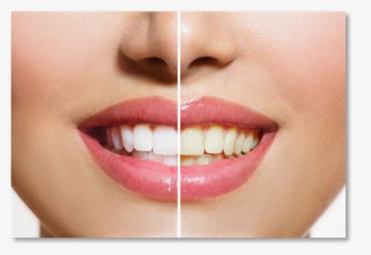 Dental Problems Before After, HD Png Download, Free Download