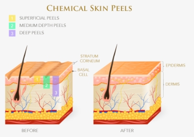 Infographic On Chemical Skin Peels - Layers Of Skin Chemical Peel, HD Png Download, Free Download