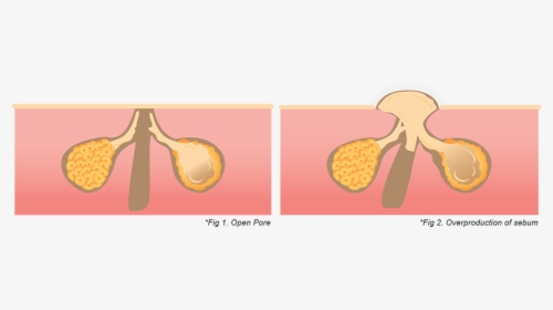 Acne Scars Graphic - Illustration, HD Png Download, Free Download