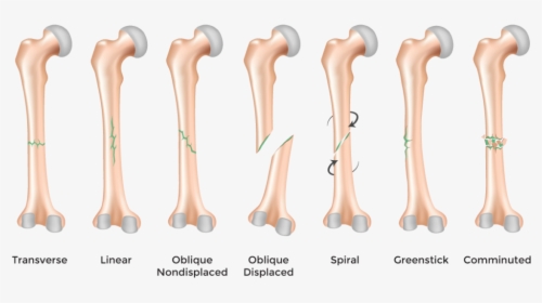 "bone Fracture - Comminuted Fracture Description, HD Png Download, Free Download