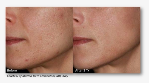 Before/after With Lutronic Infini - Before And After Infini Radiofrequency Microneedling, HD Png Download, Free Download