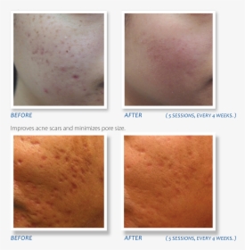 Microneedling Dermapen Before And After Milwaukee Evolvmd - Dermapen Inainte Si Dupa, HD Png Download, Free Download