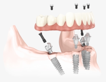 Model Drawing Of All On Four Dental Implants And Components - All On Four Transparent, HD Png Download, Free Download