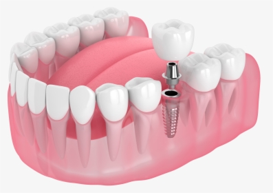 Implants Topsail Nc, HD Png Download, Free Download
