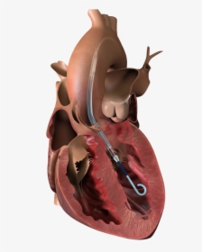 The Impella Left Ventricular Assist Device - Impella 5.5, HD Png Download, Free Download